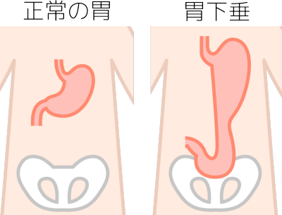 正常の胃と胃下垂