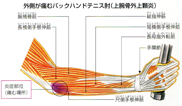 テニス肘（上腕骨外側上顆炎）