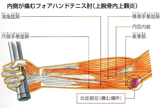 テニス肘（上腕骨内側上顆炎）