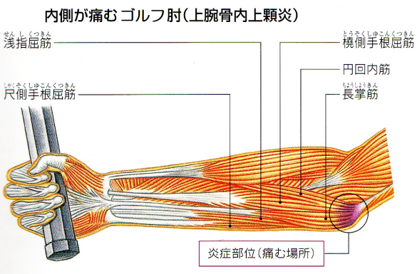 ゴルフ肘