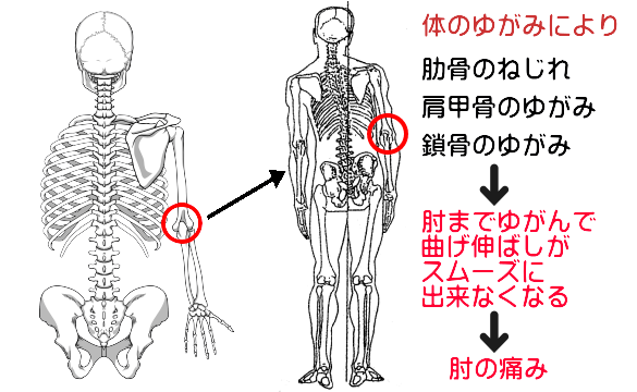 体のゆがみと肘の痛み