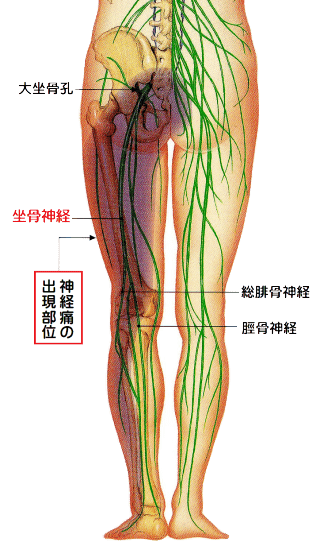 坐骨神経痛