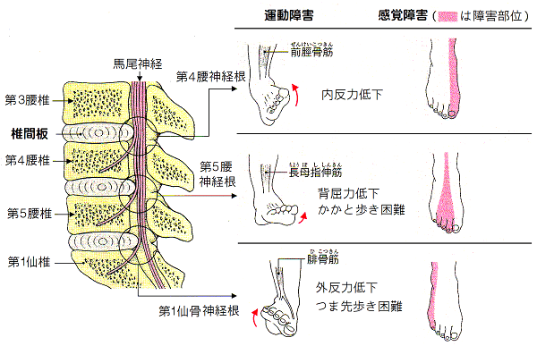 腰椎椎間板ヘルニア