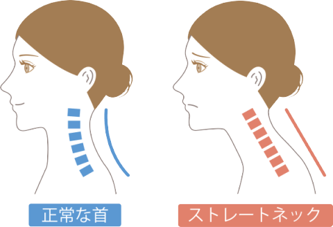 ストレートネック